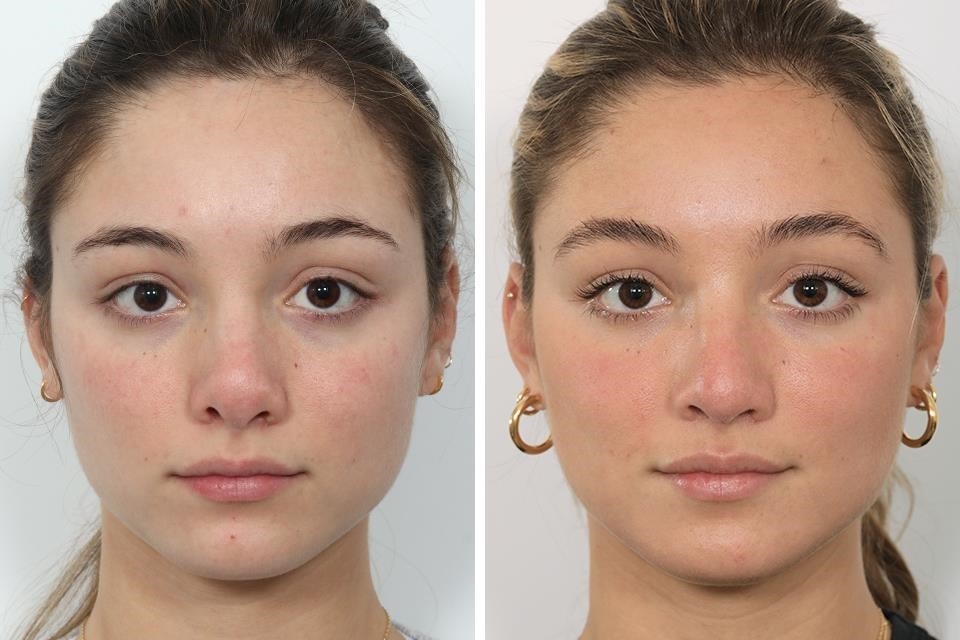 best rhinoplasty surgeons