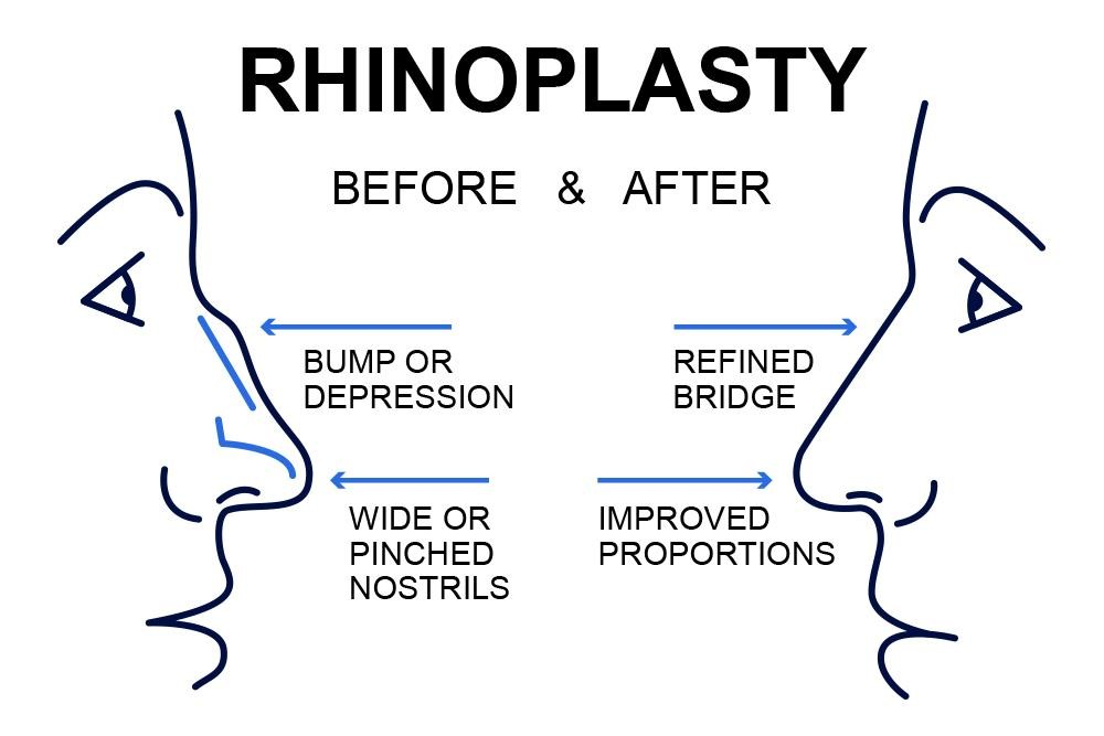 best rhinoplasty surgeons